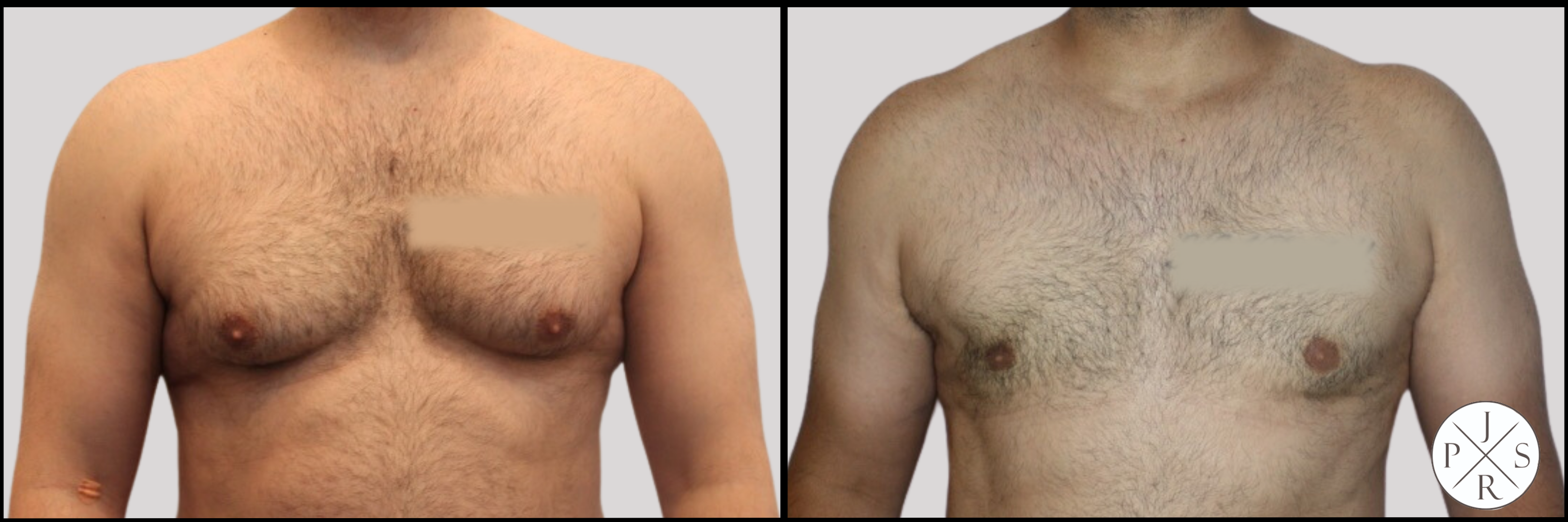 Gynecomastia Before & After Image